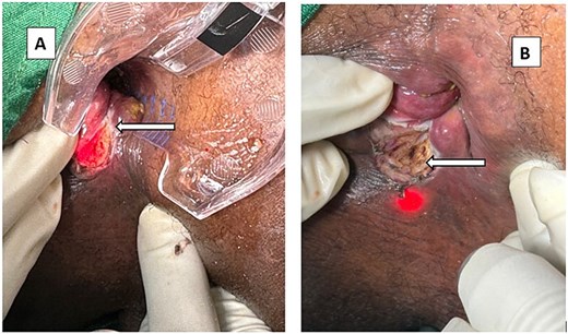 (A) The treated papilla at the apex of the fissure (arrow). Appearance of a CAF after LaFiP. (B) The tissue of the fleshy ulcer turns gray after treatment (arrow). Appearance of a CAF after LaFiP.