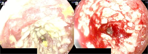 Circumferential jejunal ulcer measuring >5 cm, with loss of vascular pattern, induration, whitish exudate, and contact bleeding.