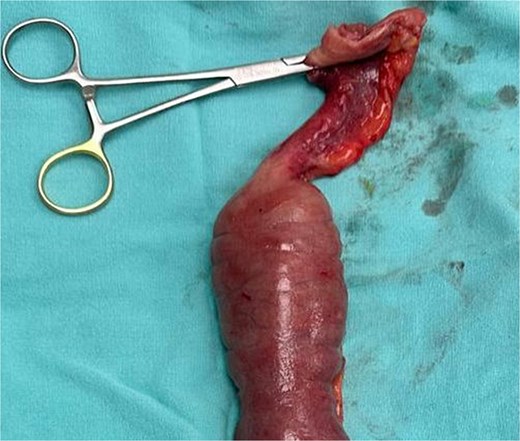 Stenotic thickened jejunal segment.