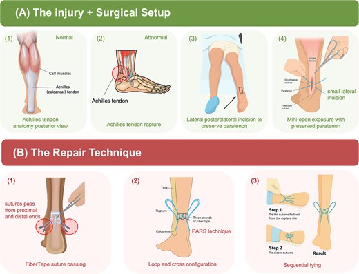 Illustration of the modified limited-open Achilles tendon repair technique. (A) The injury and surgical setup. (B) The repair technique.