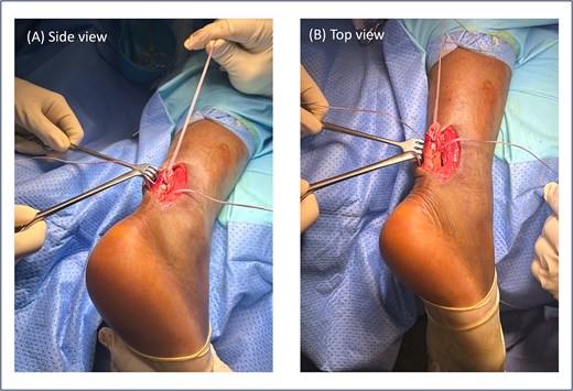 Intraoperative views of Achilles tendon repair in Patient 1 using the modified Bunnell technique. (A) Side view (A) and top view (B) demonstrate three crisscrossed FiberTape loops applied with sequential tensioning.