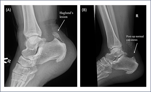 Pre- and postoperative lateral ankle X-ray of Patient 5. (A) Pre-operative shows a prominent Haglund’s lesion before surgery. (B) The postoperative image demonstrates a normalized calcaneal contour following debridement and Achilles tendon repair, suggesting adequate resection and restoration of the tendon insertion profile.