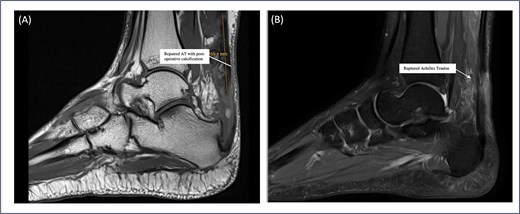 Sagittal MRI sequences of Patient 5 showing calcific changes and tendon status. (A) MRI highlights a 6 mm postoperative calcification near the Achilles tendon insertion site. (B) MRI confirms intact Achilles tendon continuity with no evidence of re-tear.