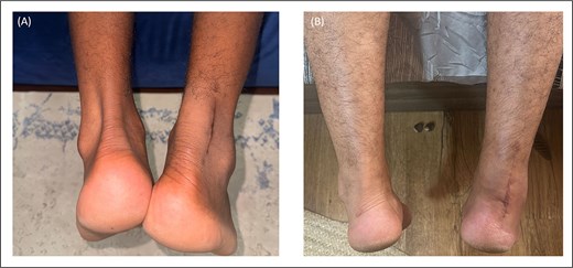 Post-operative images of healed ATR scars demonstrating minimal scarring, well-approximated skin edges, and absence of any wound complications.