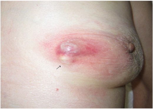 The left breast of a 93-year-old woman showing a nodule (arrow) of ~1 cm in diameter in the inner-lower region. This was accompanied by redness, blistering, and soreness of the surrounding skin.