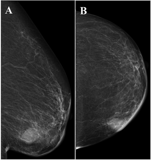 Left breast mammography showing a focal asymmetric density of ~1 cm in diameter in the inner-lower region. (A) Medio-lateral oblique view, (B) cranio-caudal view.