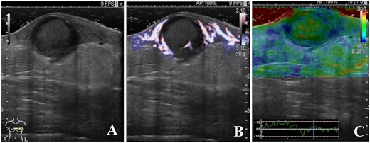 B-mode ultrasound imaging revealed that the nodule had an ill-defined, oval-shaped, and demonstrated dorsal acoustic amplification and lateral shadowing and heterogeneous pattern with a hypoechoic rim (A). Color doppler sonography showed blood flow signals mainly around the nodule (B), and on ultrasound elastography, the nodule appeared green-to-orange (C).