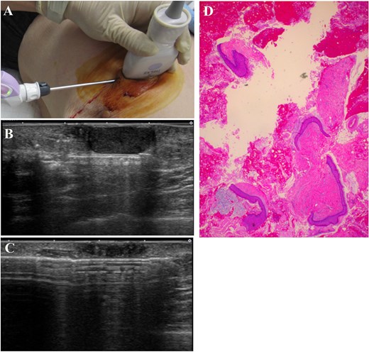 The operating needle was advanced through the skin incision (A) and positioned posterior to the lesion (B). The lesion was excised toward the skin using a rotating blade with vacuum aspiration (C). Histological examination revealed that the lesion comprised mature stratified squamous epithelium and laminated layers of keratin, which was consistent with the findings of an epidermal cyst (D, Hematoxylin and eosin stain).