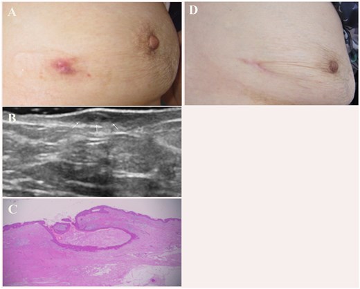 A red nodule of 4–5 mm in diameter remained following vacuum-assisted biopsy device treatment (A). B-mode ultrasound imaging showed skin thickening with a cystic lesion (arrow) (B). Pathologically, the lesion was identified as a remnant of the epidermal cyst (C, Hematoxylin and eosin stain). There was no evidence of recurrence at 3 years post-surgery (D).