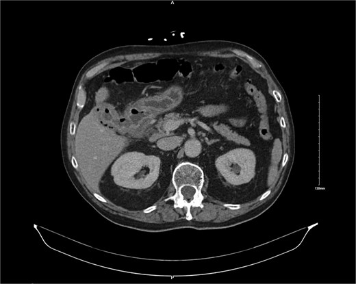 CT image showing cholocystoduodenal fistula at initial presentation.