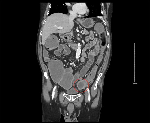 CT image showing 3 cm gallstone obstructing the sigmoid colon.