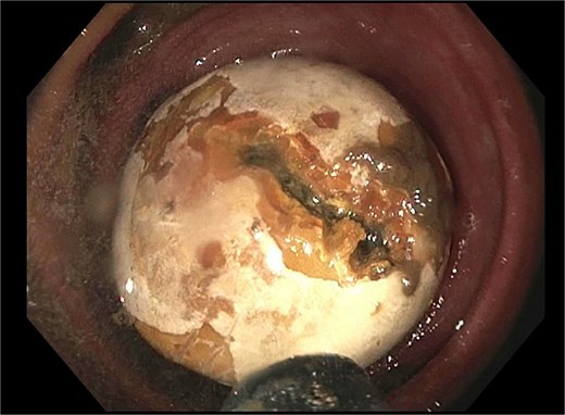 Endoscopic view of gallstone impacted at diverticular stricture.