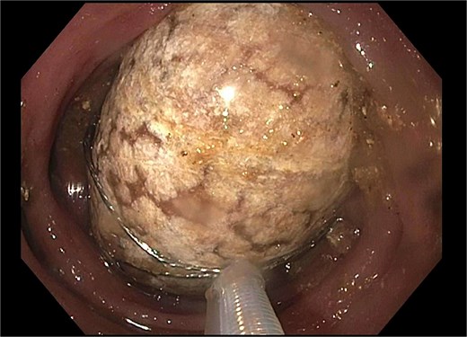 Trapezoid basket used to engage the stone.