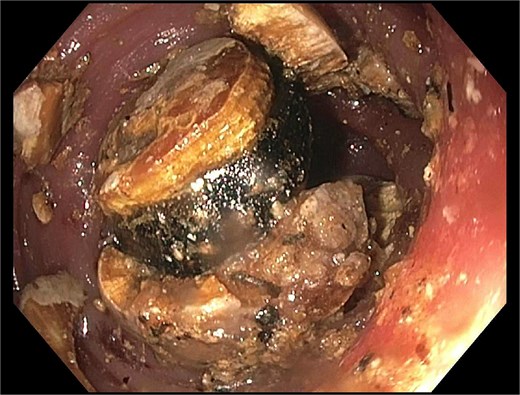 Fragmentation with mechanical lithotripsy.