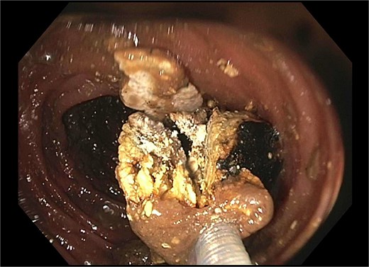 Residual gallstone with evidence of central cleavage.