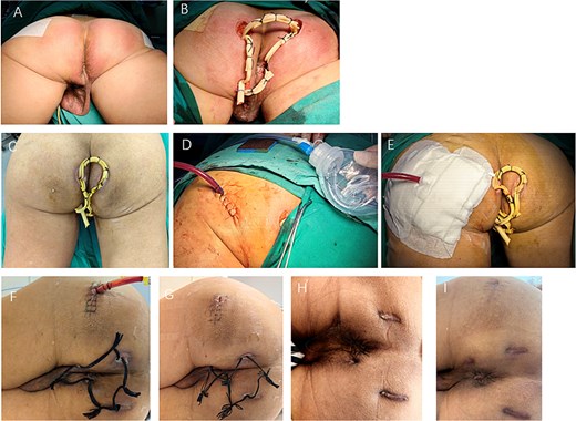 Clinical photographs from preoperative to follow-up stages. (A) Pre-op day 1: bilateral perianal swelling with erythema, induration, raised tense skin, and significant tenderness, without obvious fluctuation or skin breakdown. (B) Operative day: perianal abscess drainage. (C) Postoperative day 7: skin swelling and significant tenderness in the left gluteal and groin regions. (D) Postoperative day 7: negative pressure catheter drainage was performed to evacuate the deep gluteal abscess under spinal anesthesia. (E) Postoperative day 7: the deep gluteal abscess drainage. (F) Postoperative day 2: perianal drainage catheters were converted to lose seton. (G) Postoperative day 3: the gluteal catheter was successfully removed. (H) Postoperative day 8: complete recovery was achieved. (I) Postoperative day 6: no recurrence.