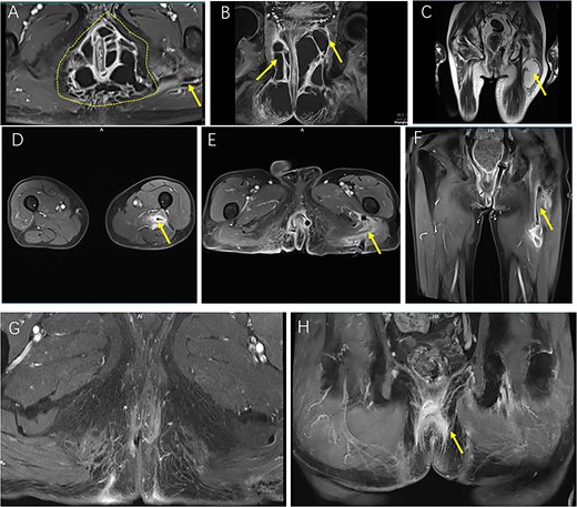 Sequential MRI images illustrating the preoperative extent, postoperative course, and resolution of a complex horseshoe perianal abscess with deep gluteal involvement following surgical drainage. (A, B) Preoperative CE FS-T1-TSE axial (A) and coronal (B) MRI images demonstrate a complex horseshoe-shaped perianal abscess involving both ischiorectal fossae (outlined by a dashed line). The abscess extends superiorly to the apex of the left ischiorectal fossa with associated inflammatory changes involving the left levator ani muscle (arrow). A small secondary gluteal abscess is also noted (arrow). (C) T2WI-FS coronal MRI five days postoperatively demonstrates a deep gluteal abscess (arrow). (D–F) Two-week postoperative CE FS-T1-TSE MRI shows the gluteal region in axial view (D), the perianal region in axial view (E), and the perianal region in coronal view (F), with the left ischiorectal fossa drain accurately positioned at the apex and marked reduction of inflammatory infiltration and abscess cavities. (G, H) Follow-up CE FS-T1-TSE MRI images obtained three months postoperatively in axial (G) and coronal (H) planes show near-complete resolution of inflammation. No residual abscess is observed (arrow).