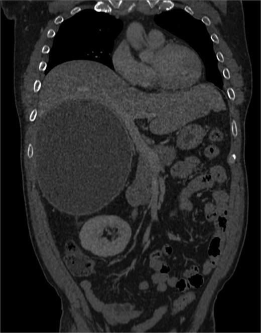 Cystic mass with mural calcification and tissue components in the posteroinferior portion, closely abutting the right kidney and adrenal.