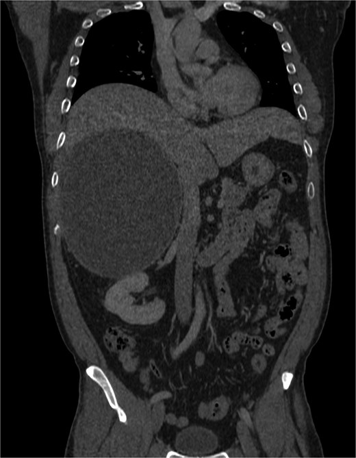 Cystic mass with mural calcification and tissue components in the posteroinferior portion, closely abutting the right kidney and adrenal.