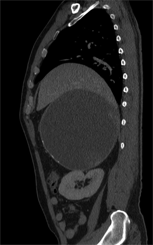 Cystic mass with mural calcification and tissue components in the posteroinferior portion, closely abutting the right kidney and adrenal.