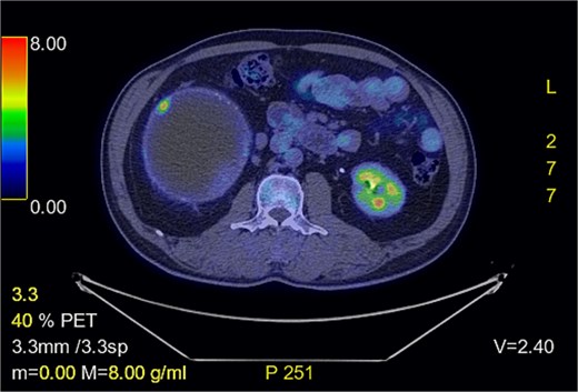 FDG-PET shows focal hypermetabolic activity in the cyst wall.