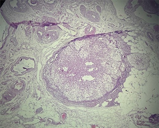 Ectopic adrenal cortical tissue in the mesosalpinx, forming a well-circumscribed nodule without invasive features. H&E stain, ×40.