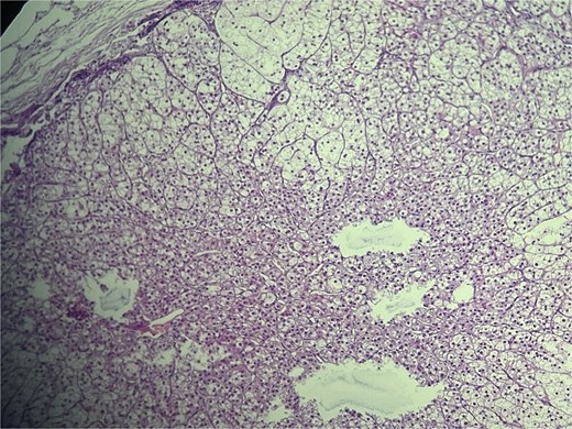 High-power view of ectopic adrenal cortex composed of polygonal cells with finely vacuolated, lipid-rich cytoplasm, and round to oval nuclei, arranged in nested/trabecular patterns resembling zona fasciculata. No medullary tissue is present. H&E stain, ×100.