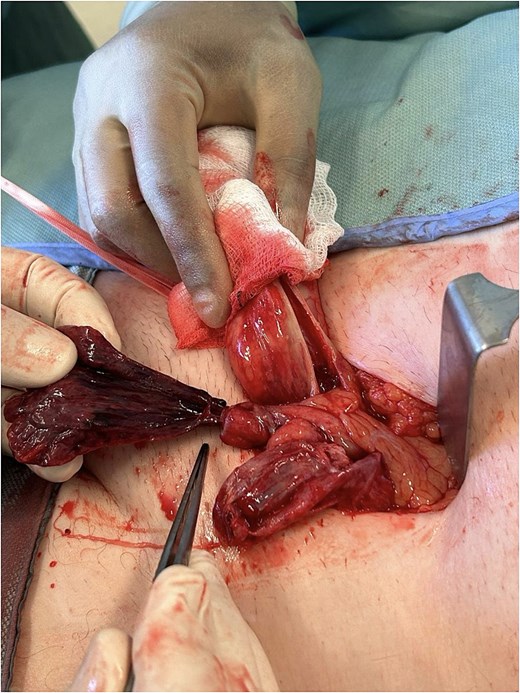 Intraoperative image showing the exposed strangulated appendix epiploica emerging from the left inguinal canal. The tissue appears dark and gangrenous.