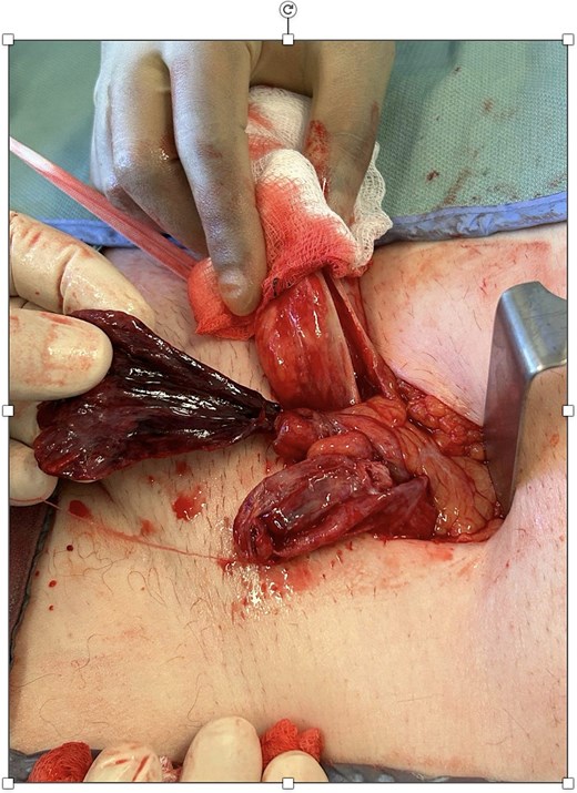 Closer intraoperative view highlighting the thickened, infarcted appendix epiploica and inflamed cord structures following sac exploration.
