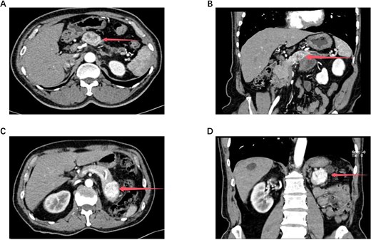 The size and location of the tumors in Cases 1 and 2 are demonstrated by abdominal contrast-enhanced computed tomography (CT) and three-dimensional (3D) reconstruction. Figure 1A shows the tumor in Case 1, and Fig. 1C shows the tumor in Case 2. The corresponding 3D reconstruction results for Cases 1 and 2 are presented in Fig. 1B and Fig. 1D, respectively.