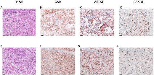 The immunohistochemical staining results for H&E (40x), CA9 (40x), AE1/AE3 (40x), and PAX8 (40x) in Case 1 (Fig. 2A–D) and Case 2 (Fig. 2E–H).