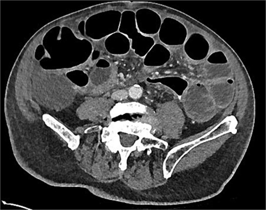 Day 7 CT scan demonstrating features consistent with ileus with no pneumoperitoneum and rectal contrast proximal to anastomosis without contrast extravasation.