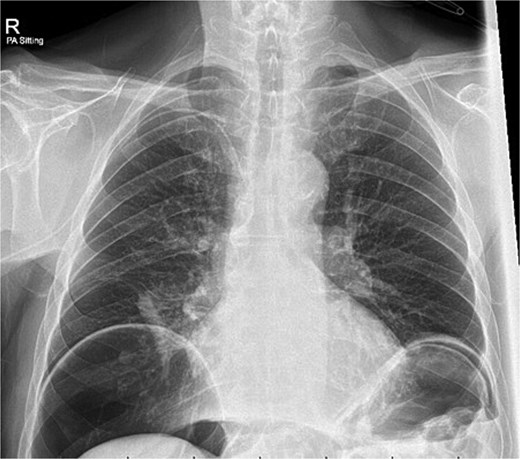 Day 10 chest x-ray demonstrating massive pneumoperitoneum.