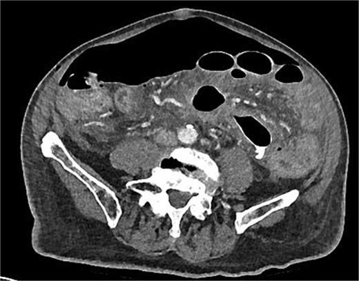 Day 10 CT scan demonstrates ileus with large volume pneumoperitoneum with free air around anastomosis.