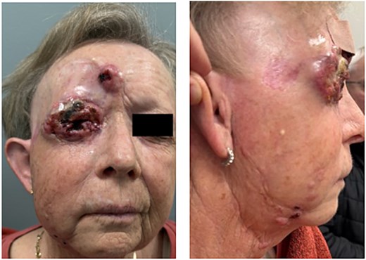 Locoregional recurrence characterized by an ulcerated frontal and periorbital mass, facial edema, and nodal metastases.