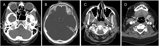 CT head showing (A) right periorbital mass, (B) anterior soft tissue lesion along the forehead medial to the site of prior frontal bone decortication, (C + D) nodal and dermal metastatic deposits within the right neck.