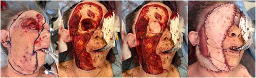 Intraoperative photos demonstrating radical resection including orbital exenteration, resection of dermal metastases, and bilateral neck dissection, followed by facial reconstruction utilizing a free VRAM flap, pectoralis major flap, scalp rotation flap, and skin grafting.