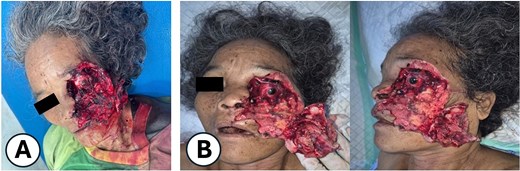 Clinical presentation of the patient after a bear mauling. (A) Initial condition upon arrival at Pagar Alam District Hospital. (B) Condition upon admission to Dr. Mohammad Hoesin Hospital as the referral center.