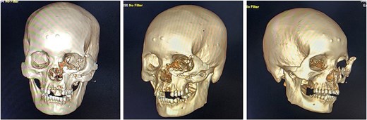CT scan findings of the patient after a bear mauling.