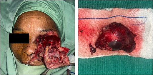 Intraoperative appearance of the patient following exenteration.