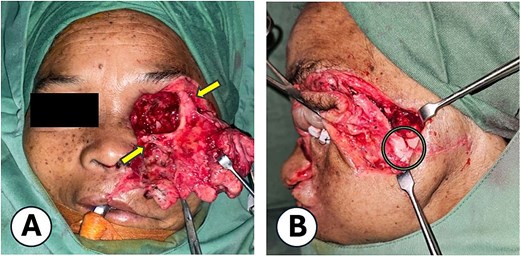 Internal fixation technique. (A) Application of wire for stabilization of the midfacial fracture, with fixation at the zygomaticofrontal bone and lower orbital rim (maxilla). (B) Anatomical realignment of the fracture segments. Following wire fixation, proper alignment of the zygomatic arch was achieved.
