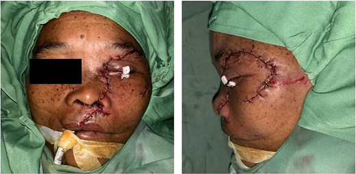 Immediate postoperative outcome. Anatomical repositioning and puzzle-like soft-tissue re-approximation were performed after debridement, exenteration, and fracture fixation.