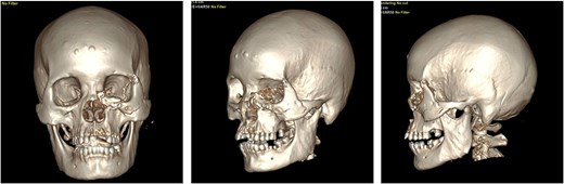 Postoperative CT evaluation demonstrating successful bony consolidation and stable wire fixation.