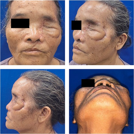 Clinical condition at the 4-month postoperative follow-up.