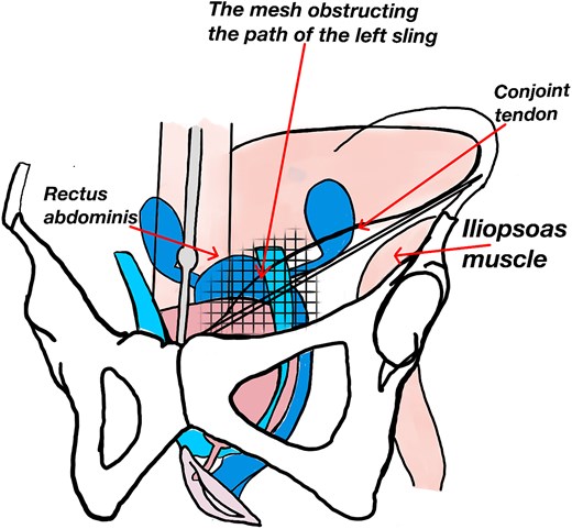 Illustration of the mechanical resistance encountered during left retropubic passage of the TVT sling.