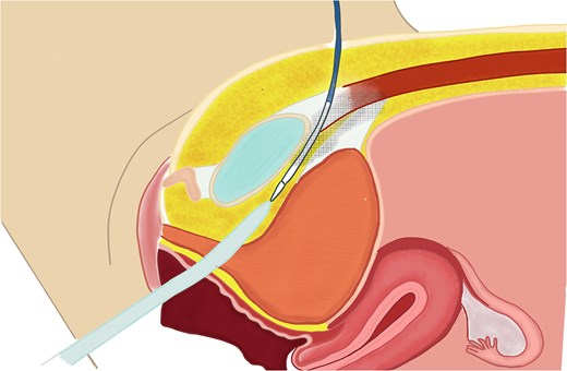 Sagittal illustration of sling passage interference.