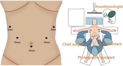 Trocar and position.