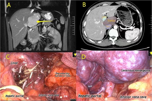(A) MRI examination; (B) CT examination; (C–D) Laparoscopic resection of caudate lobe hemangioma procedure.