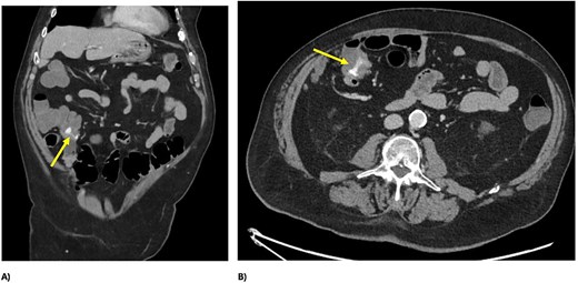 Computed tomography slices showing contrast blush in the caecum and appendiceal base, pre-embolization.
