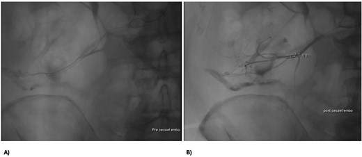 Abdomen angiography demonstrating successful ileocaecal angioembolization.